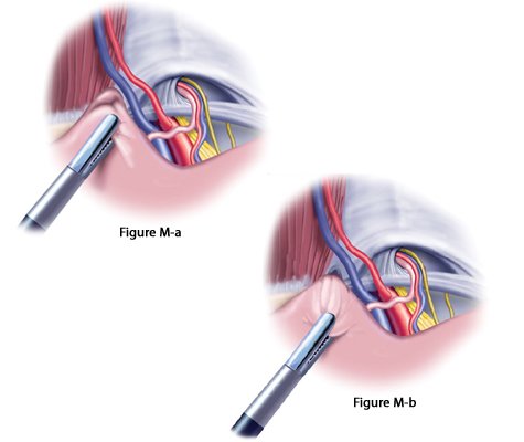 Laparoscopic Inguinal Hernia Repair